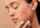 4 Common Skin Issues and Their Home Remedies