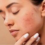 4 Common Skin Issues and Their Home Remedies