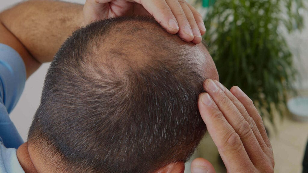 Is Hair Transplant the Best Option for Me?