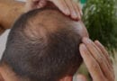Is Hair Transplant the Best Option for Me?