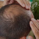 Is Hair Transplant the Best Option for Me?
