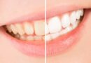 <strong>What to Expect During Teeth Whitening Treatments</strong>