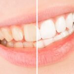 <strong>What to Expect During Teeth Whitening Treatments</strong>