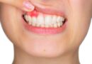 <strong>5 Signs of Unhealthy Gums</strong>