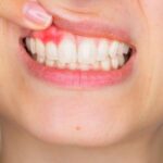 <strong>5 Signs of Unhealthy Gums</strong>