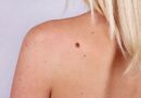 <strong>When to Get a Mole Checked Out: 7 Signs It’s Time to See a Dermatologist</strong>
