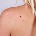 <strong>When to Get a Mole Checked Out: 7 Signs It’s Time to See a Dermatologist</strong>