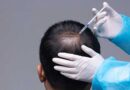 Considering a Second Hair Transplant? Here’s Why You Should Go For It
