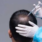 Considering a Second Hair Transplant? Here’s Why You Should Go For It