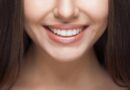 Achieving the Perfect Hollywood Smile with Veneers 