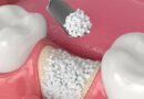 Understanding Bone Grafting: When It’s Needed and What to Expect