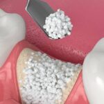 Understanding Bone Grafting: When It’s Needed and What to Expect