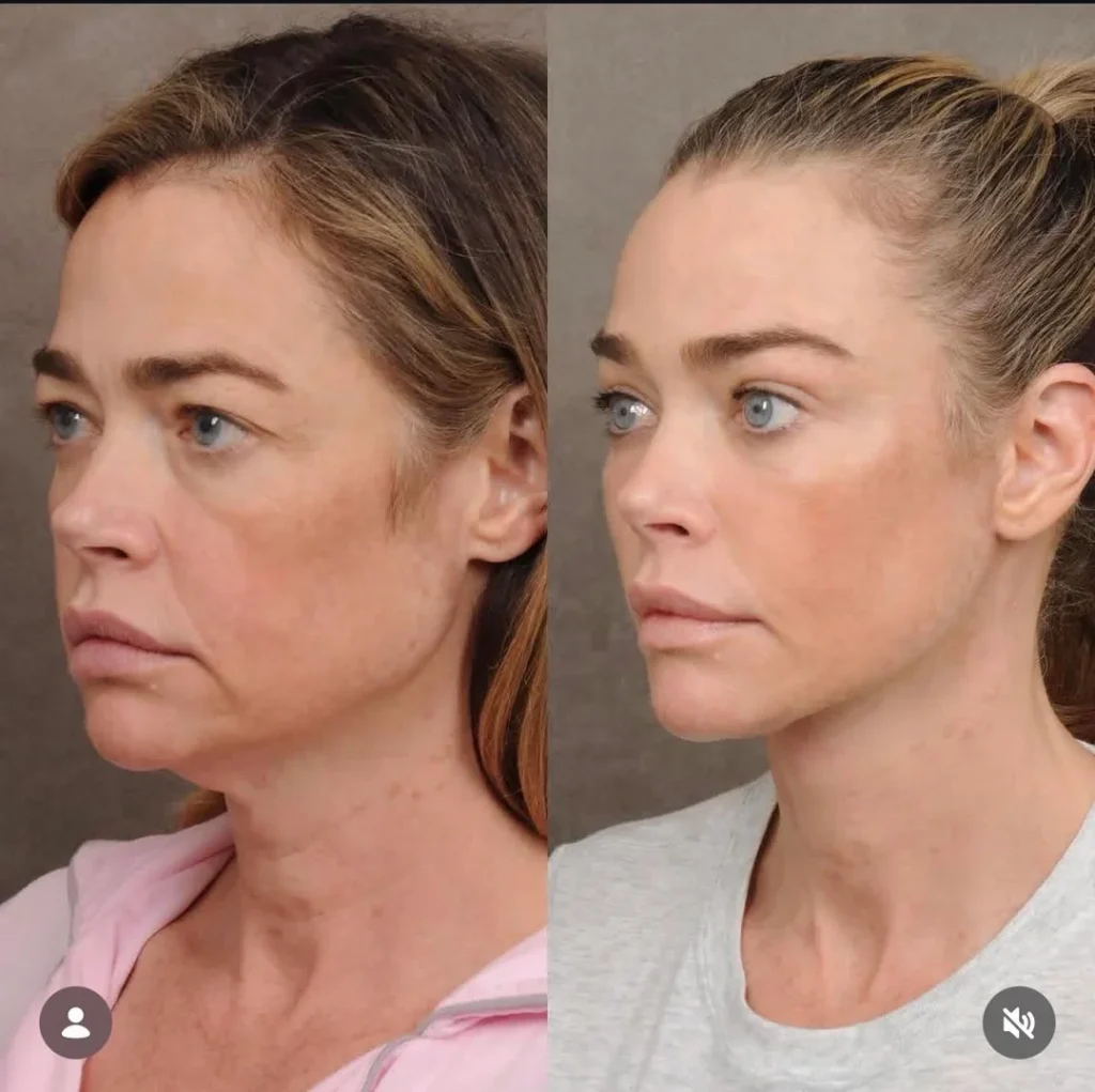 Denise Richards’ Facelift Stuns Fans as Doctor Calls Result ‘Witchcraft’
