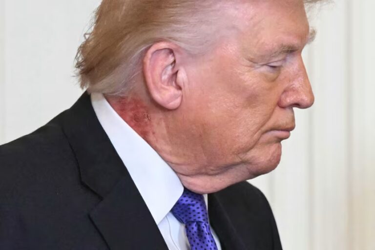 New Photos Show Prominent Neck Rash on Donald Trump During White House Remarks