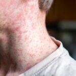 Measles Cases Surge 429+ in Canada 2026 as Flight Exposure Sparks Health Alert