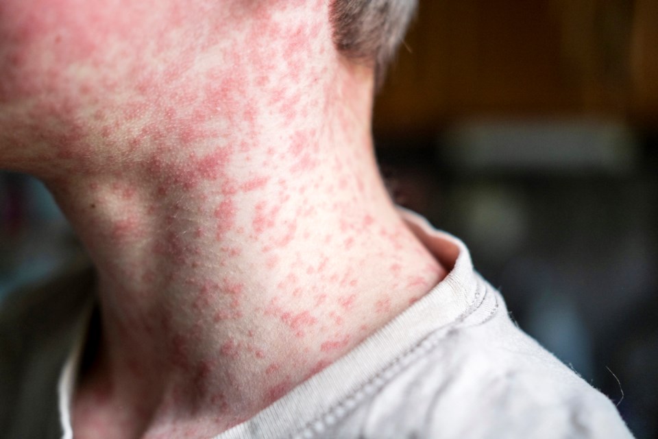 Measles Cases Surge 429+ in Canada 2026 as Flight Exposure Sparks Health Alert